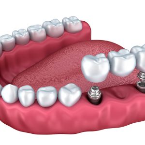 Implantologia dentale | Verona | Studio dentistico a Verona | Studio dentistico Muraro