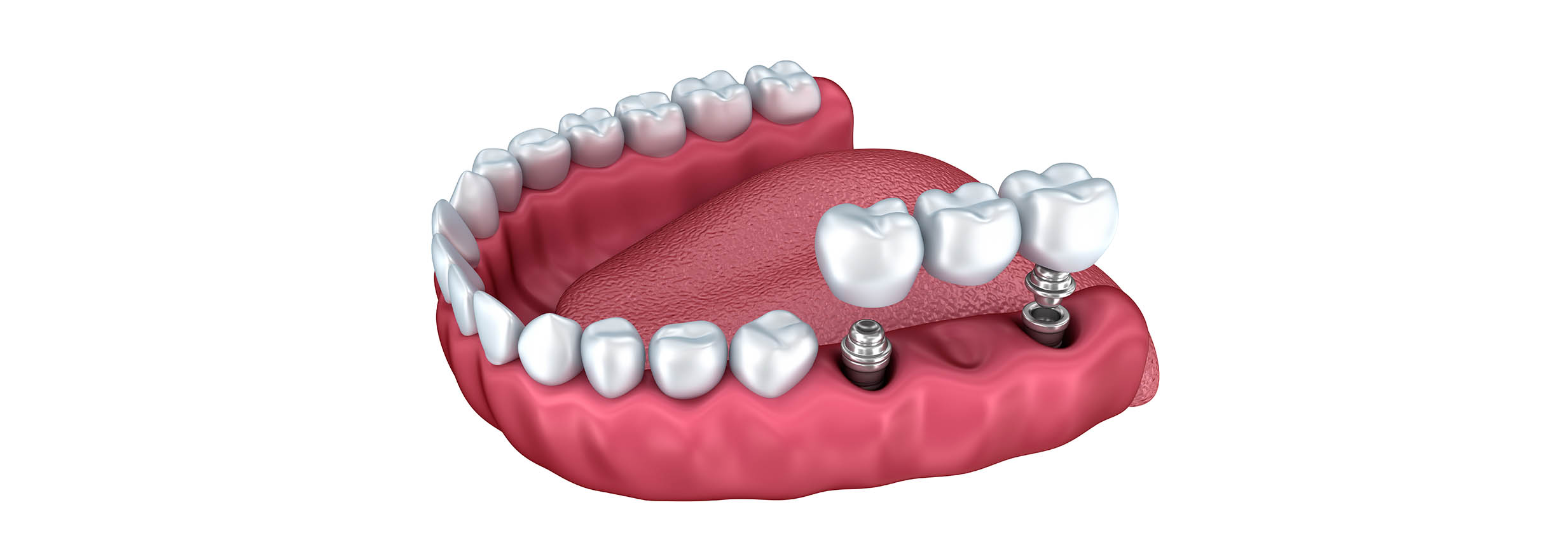 Implantologia dentale | Verona | Studio dentistico a Verona | Studio dentistico Muraro