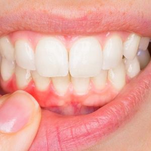 Parodontologia a Verona | Studio dentistico a Verona | Studio dentistico Muraro I