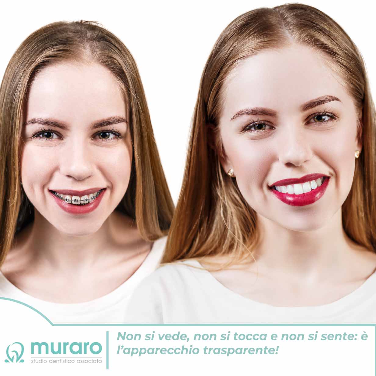 59938601_l Apparecchio Trasparente | Studio dentistico associato muraro