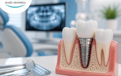 Impianti dentali: una soluzione per sostituire i denti mancanti